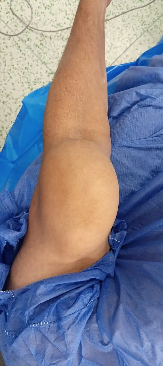 حالة معقدة.. استئصال ورم  ضخم من ذراع مريض بمستشفى العدوة المركزي
